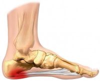 Heel Pain Center in Barrie