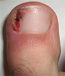 Ingrown Toenail Treatment Barrie, Ontario